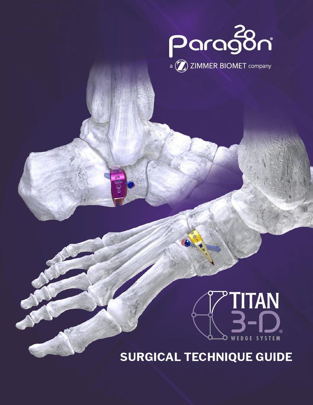 https://paragon28.com/app/uploads/2020/01/P03-STG-3001_RevB_TITAN3DWedgeSystem_STG_AUS-pdf.jpg