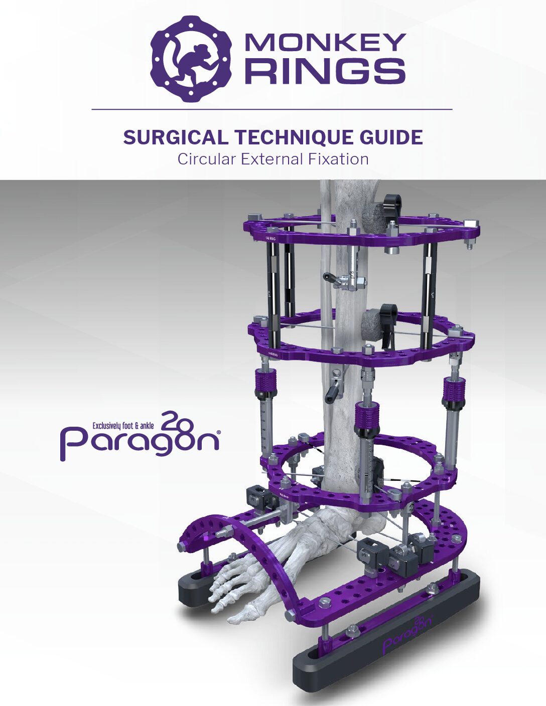 https://paragon28.com/app/uploads/2020/01/P45-STG-0001-RevJ-Monkey-Rings-Circular-External-Fixation-System-pdf.jpg