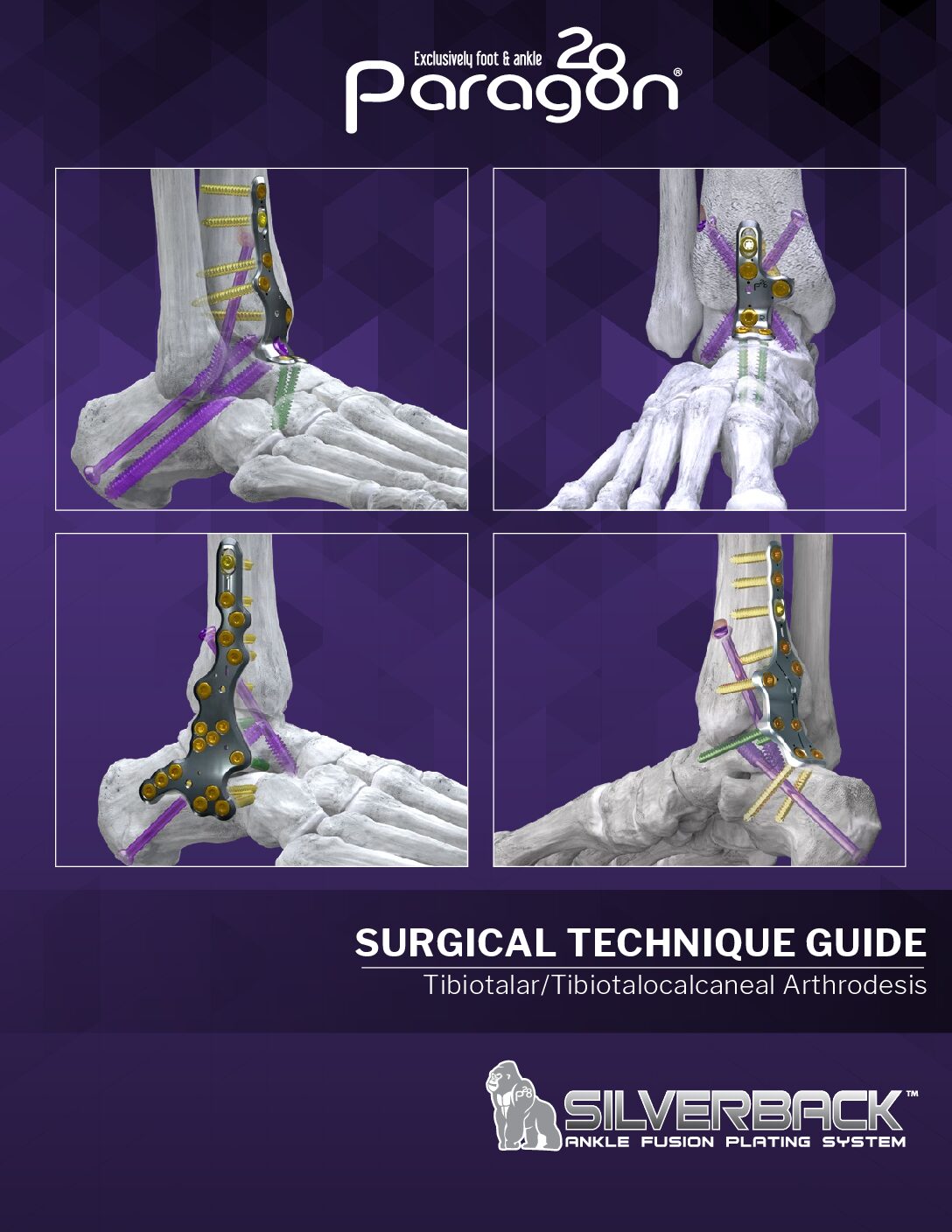 Silverback™ Ankle Fusion Plating System – Paragon 28