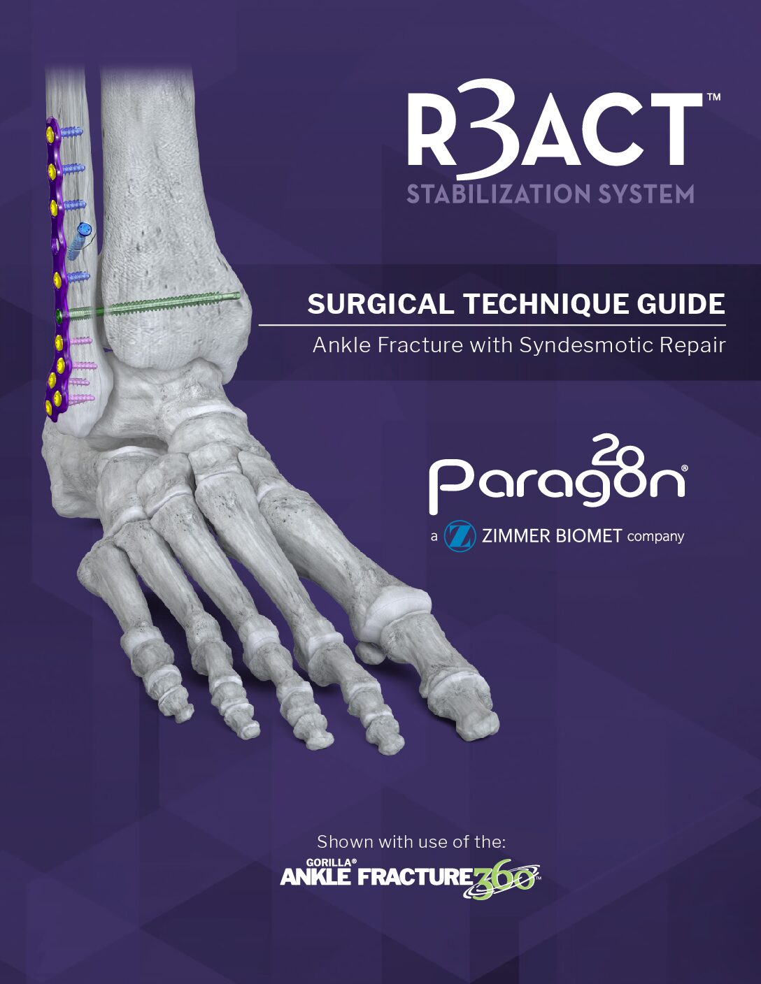 https://paragon28.com/app/uploads/2020/01/P80-STG-2001-Rev-1-R3ACT-Syndesmotic_Screw-CAN-pdf.jpg