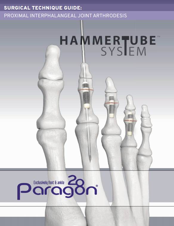 HammerTube™ System Surgical Technique Guide (US)