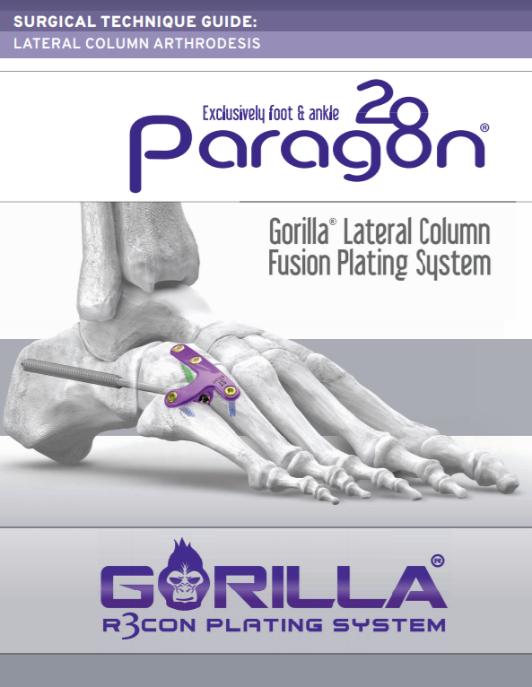 Lateral Column Plating System Surgical Technique Guide (US)