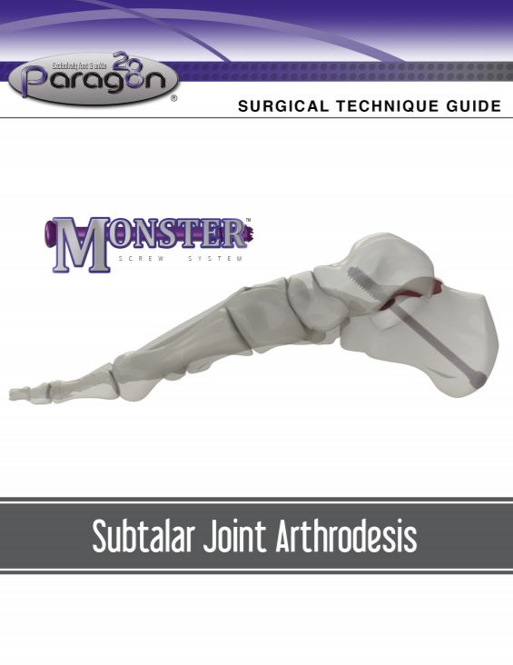 Monster® Subtalar Joint Arthrodesis Surgical Technique Guide (CAN)