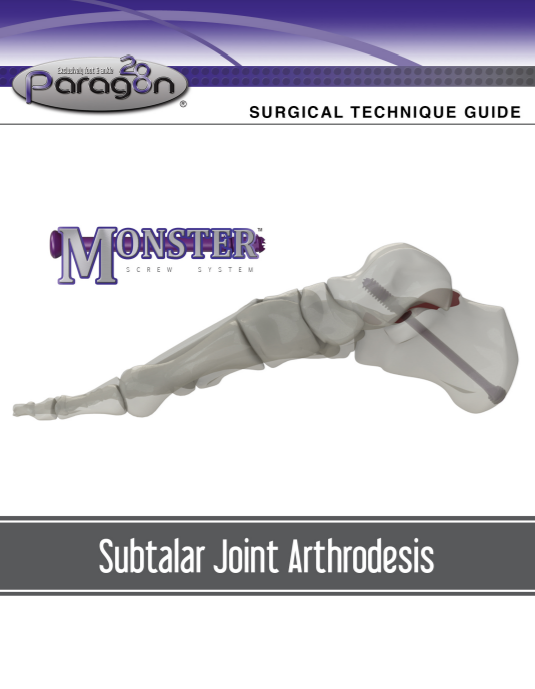 Monster® Subtalar Joint Arthrodesis Surgical Technique Guide (US)