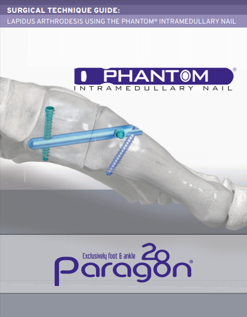 Phantom® Intramedullary Nail System Surgical Technique Guide (US)