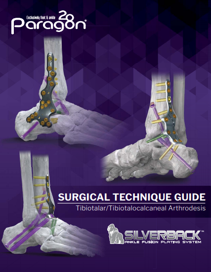 Silverback™ Ankle Fusion Plating System Surgical Technique Guide (US)