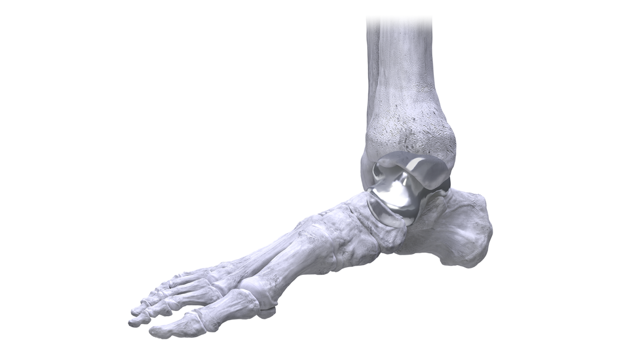 Total Talus Replacement Paragon 28