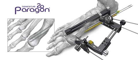 precision mis bunion system