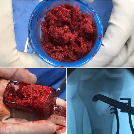 Rapid Bone and Marrow Harvesting