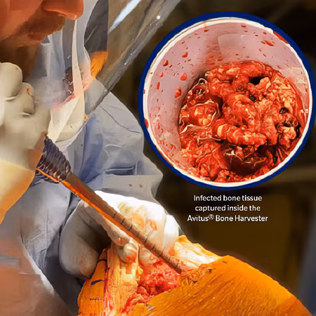 Effective Tissue Debridement