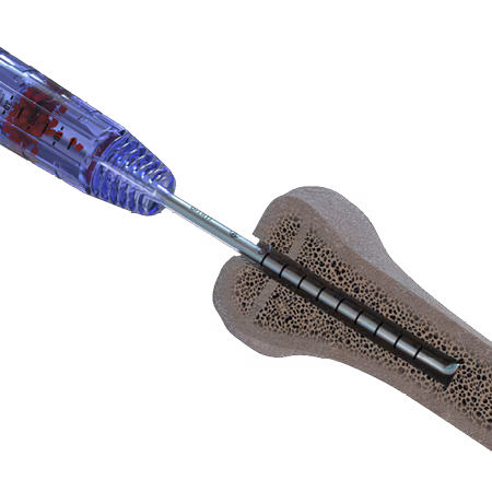 Minimally Invasive Closed Capture