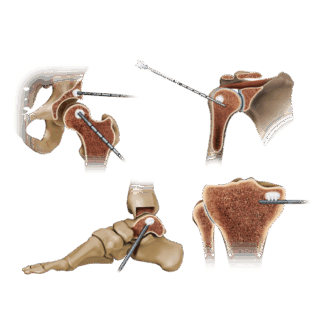 https://paragon28.com/app/uploads/2025/07/Subchondroplasty-320x320.png
