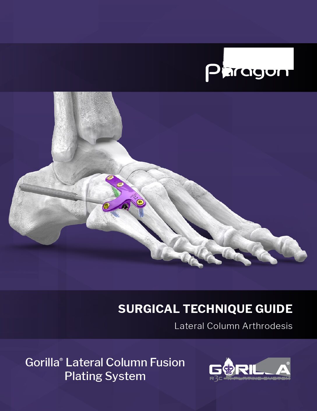 https://paragon28.com/app/uploads/2025/08/P51-STG-0010_RevF_Gorilla-Lateral-Column-Fusion-STGUS-pdf.jpg