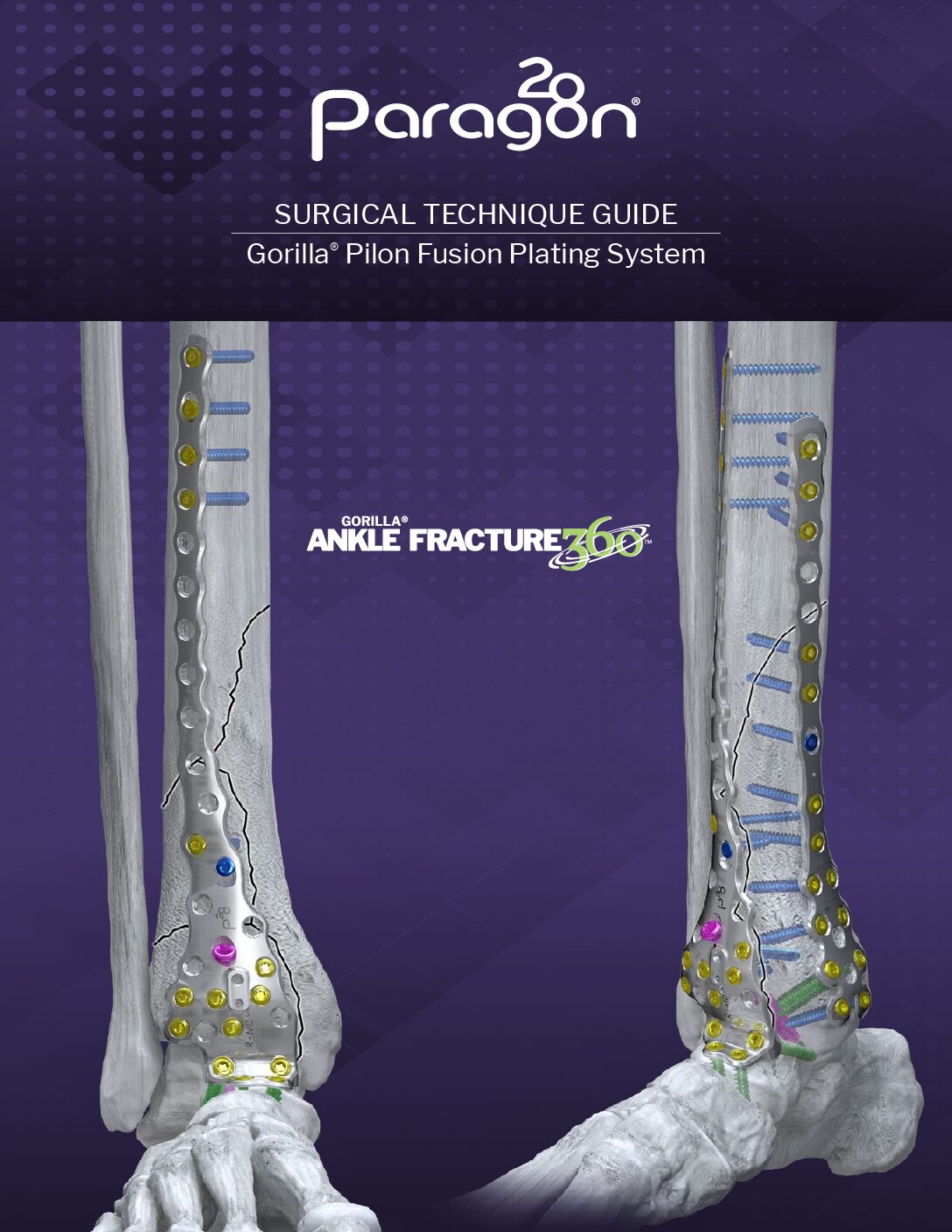 https://paragon28.com/app/uploads/2025/08/P51-STG-0015-PilonFusion_STG_RevA-US-DIGITAL-pdf.jpg