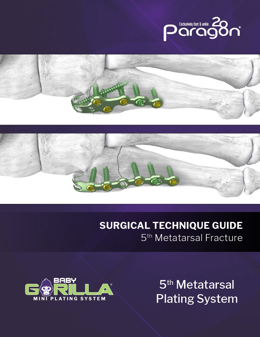 https://paragon28.com/app/uploads/2025/08/P53-STG-0002-Rev-E-Baby-Gorilla-5th-Metatarsal-Fracture-STG-US-pdf.jpg