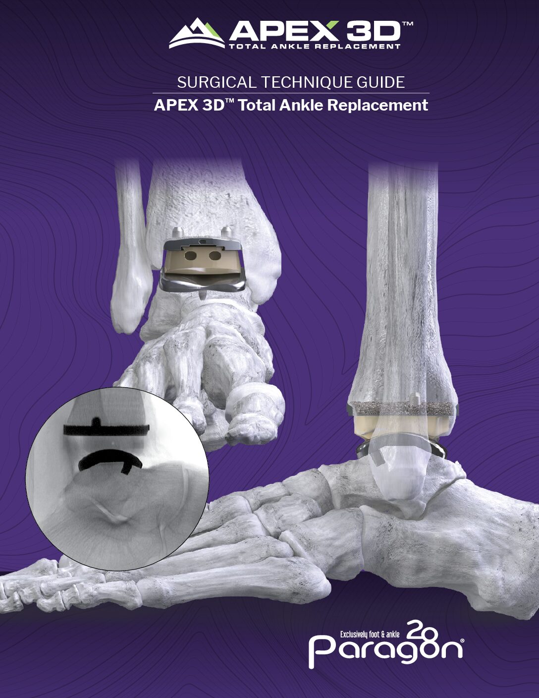 https://paragon28.com/app/uploads/2025/09/P10-STG-0001-RevK_APEX-Total-Ankle-Replacement-System-US-pdf.jpg