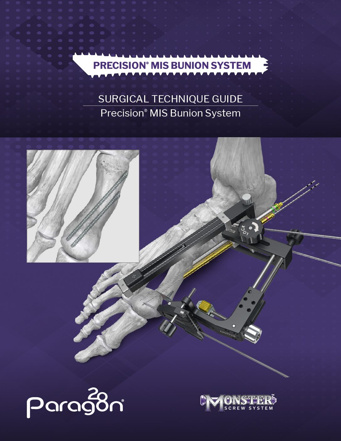 https://paragon28.com/app/uploads/2025/09/P27-STG-2001-Rev-A_Precision_MIS_Bunion_System_STG-CAN-pdf.jpg