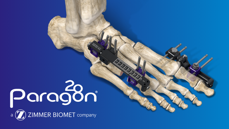 Zimmer Biomet Launches New Foot and Ankle Fixation System to Address Complex Small Bone Reconstruction