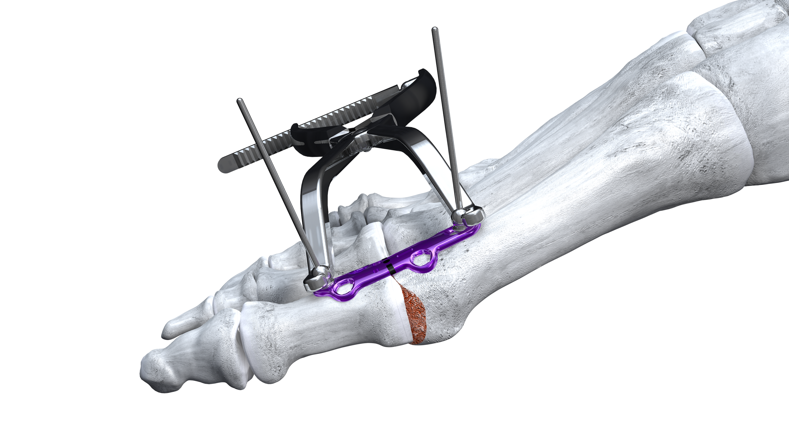 Gorilla_MTP_CompressionCl_medial