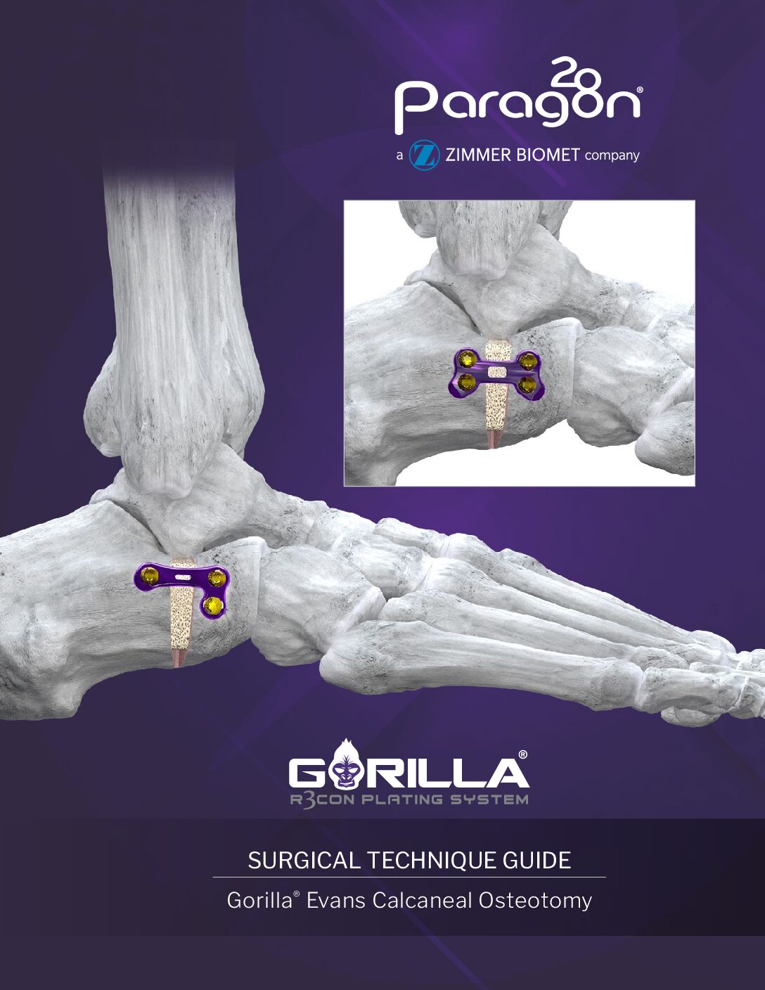 https://paragon28.com/app/uploads/2026/08/P51-STG-3005-RevC-Gorilla-Evans-Procedure-STG-AUS-pdf.jpg