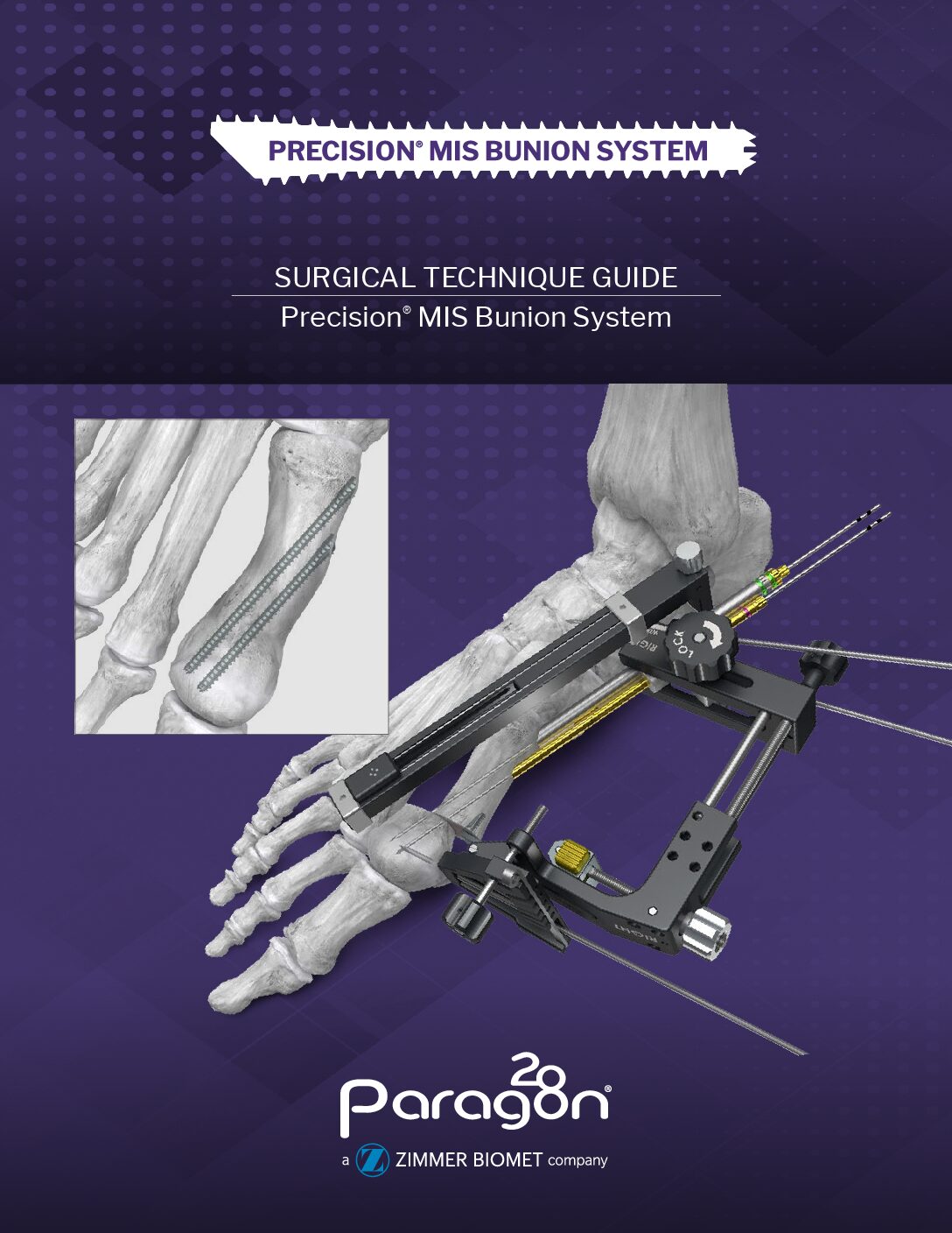 https://paragon28.com/app/uploads/2026/09/P27-STG-0001-Rev-E_Precision_MIS_Bunion_System_STG-US-pdf.jpg