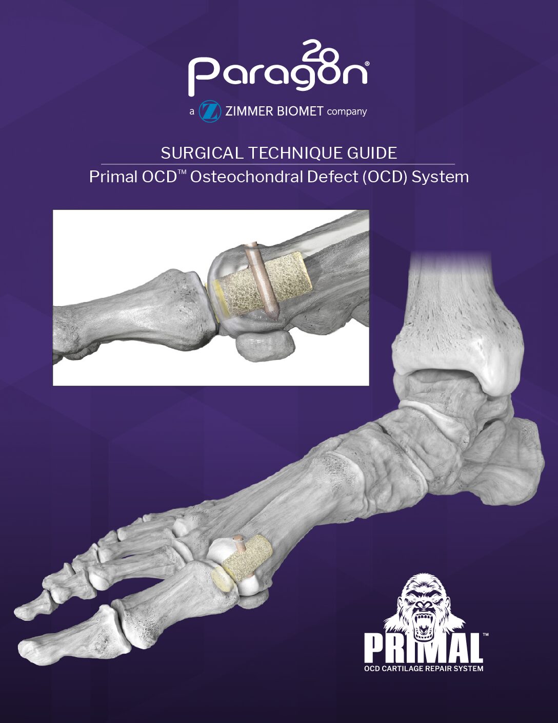 https://paragon28.com/app/uploads/2026/09/P69-STG-0001_Primal-OCD-Systems-Surgical-Technique-Guide_RevA-US-pdf.jpg