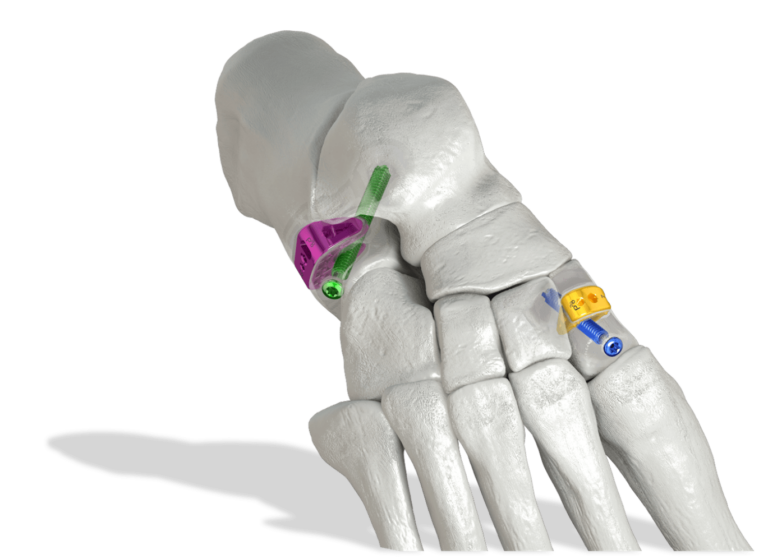 TITAN 3D™ Cotton Plantarflexing Osteotomy Wedge Paragon 28