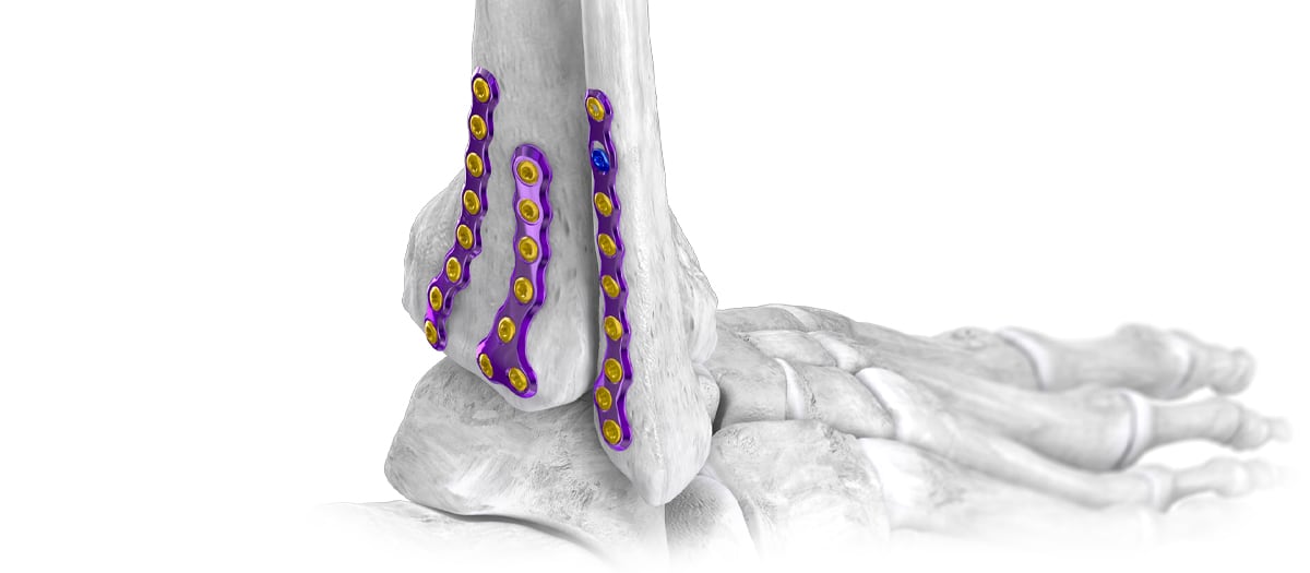 Posterior Plating System