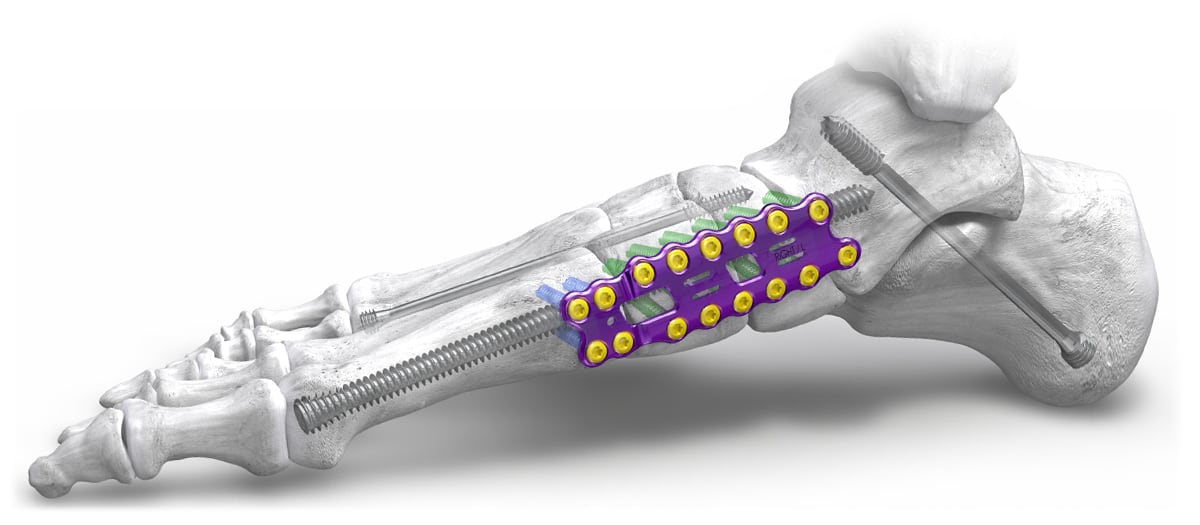 Joust™ Beaming Screw System