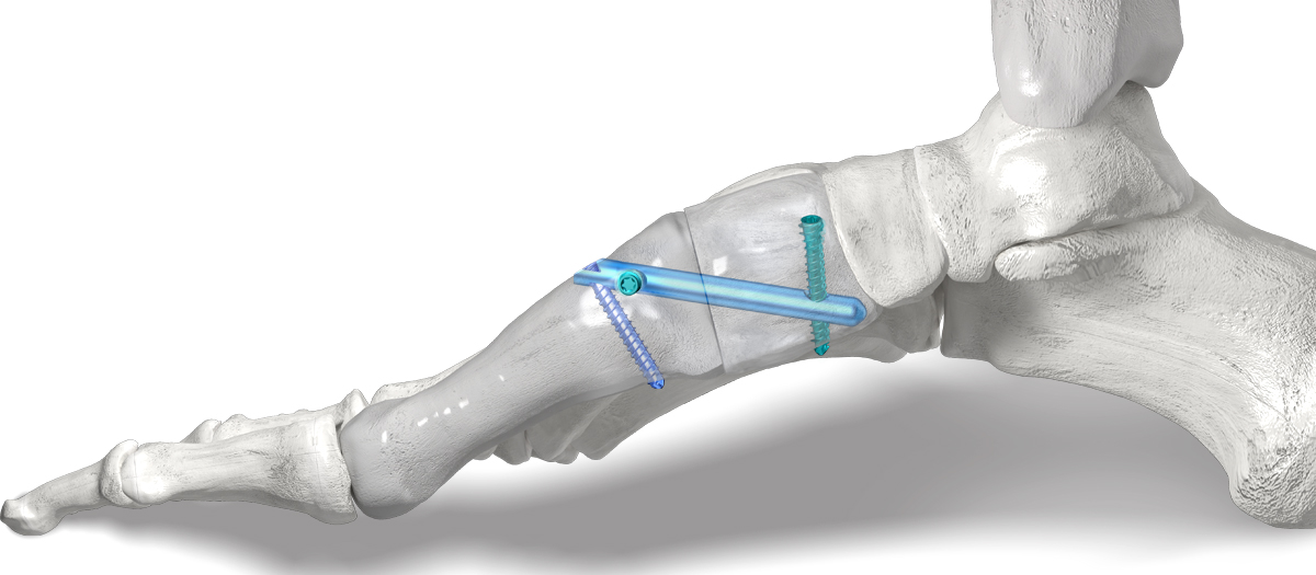 Phantom® 3-Hole Intramedullary Nail