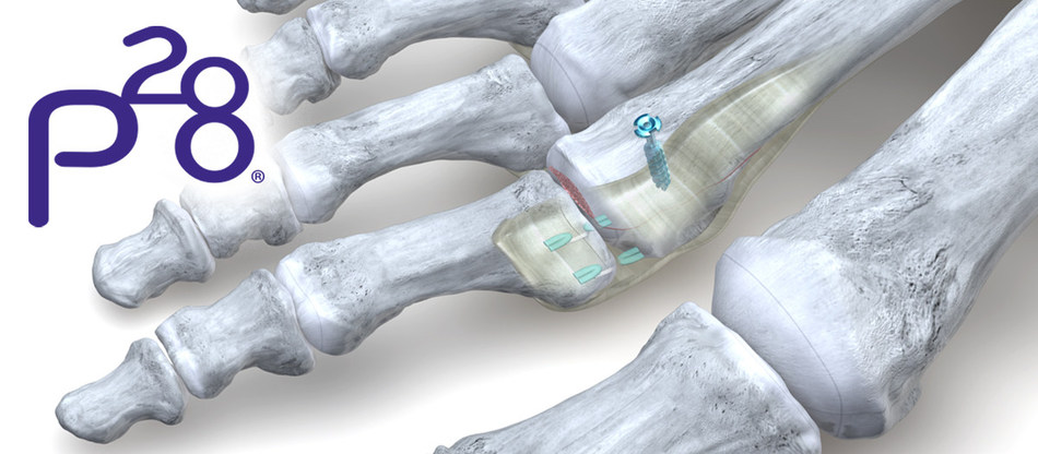 Paratrooper Plantar Plate Repair System