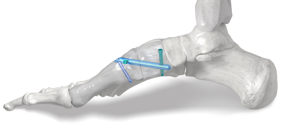 Phantom® intramedullary nail
