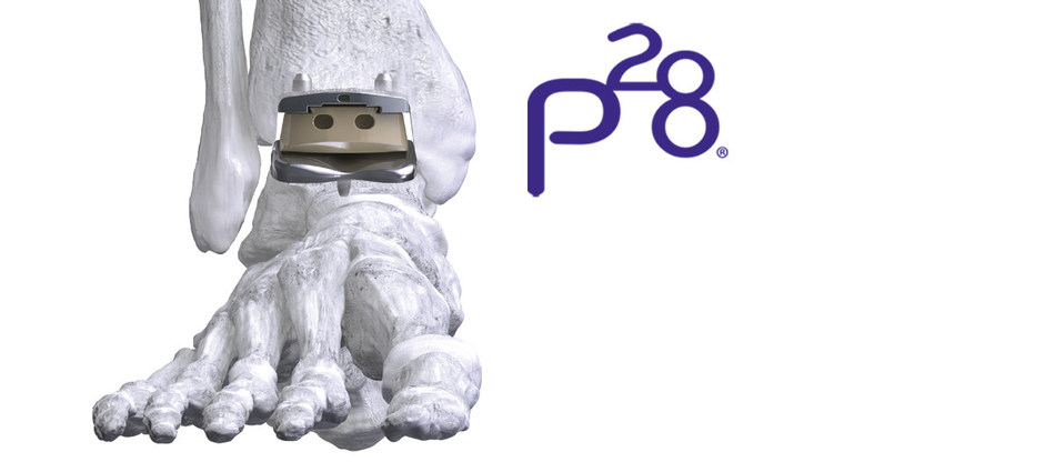 APEX 3D™ Total Ankle Replacement System.