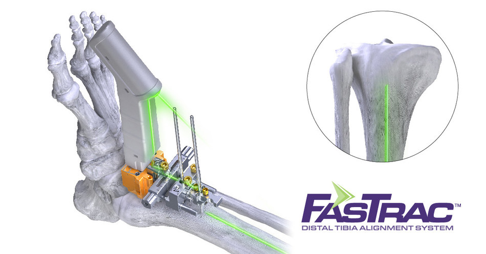 Paragon 28 FasTrac Distal Tibia Alignment System