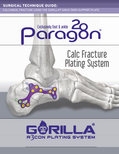 Calc Fracture Plating System Surgical Technique Guide (CE Marked)