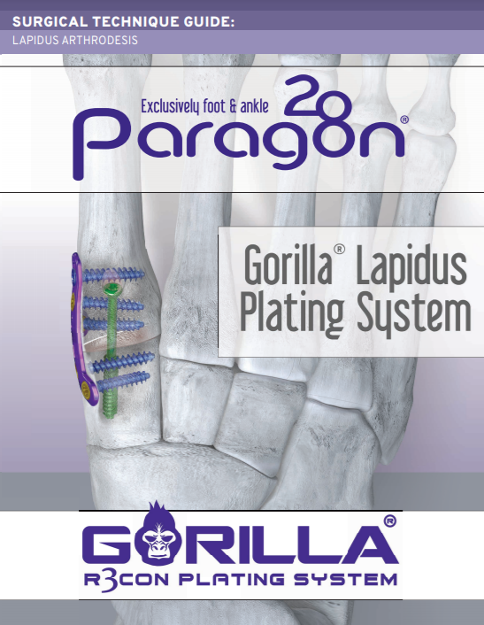 Lapidus Arthrodesis Plating System Surgical Technique Guide (CAN)