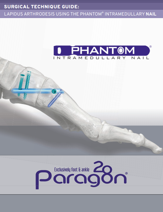 Phantom® Intramedullary 4-Hole Nail System Surgical Technique Guide (Canada)
