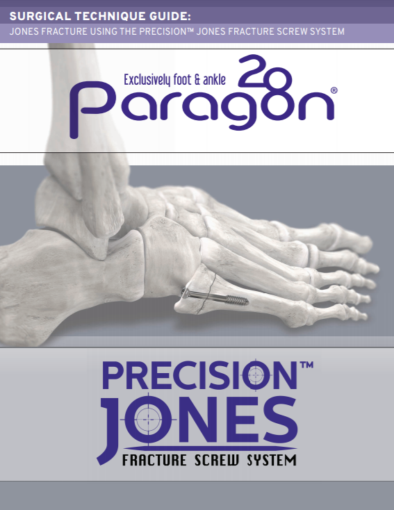 Precision Jones™ Fracture Screw System Surgical Technique Guide (CE Marked)