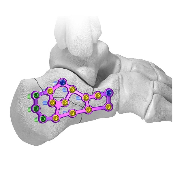 Calc Fracture