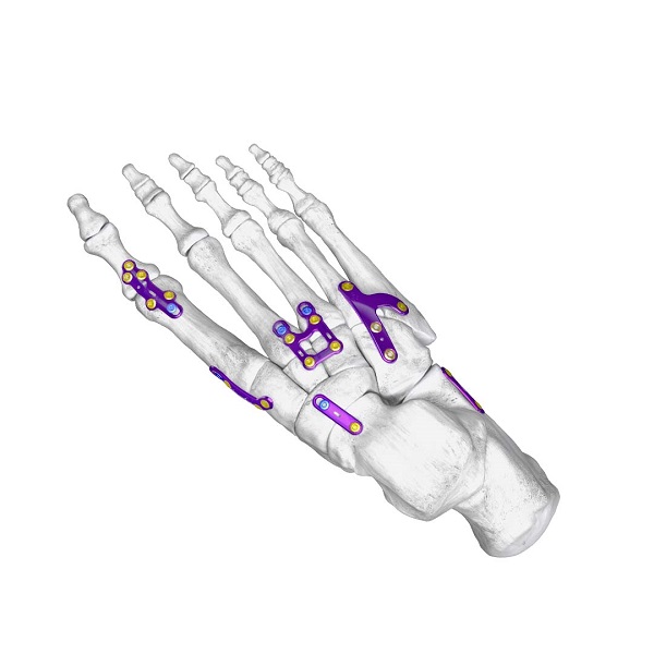 Gorilla LisFranc