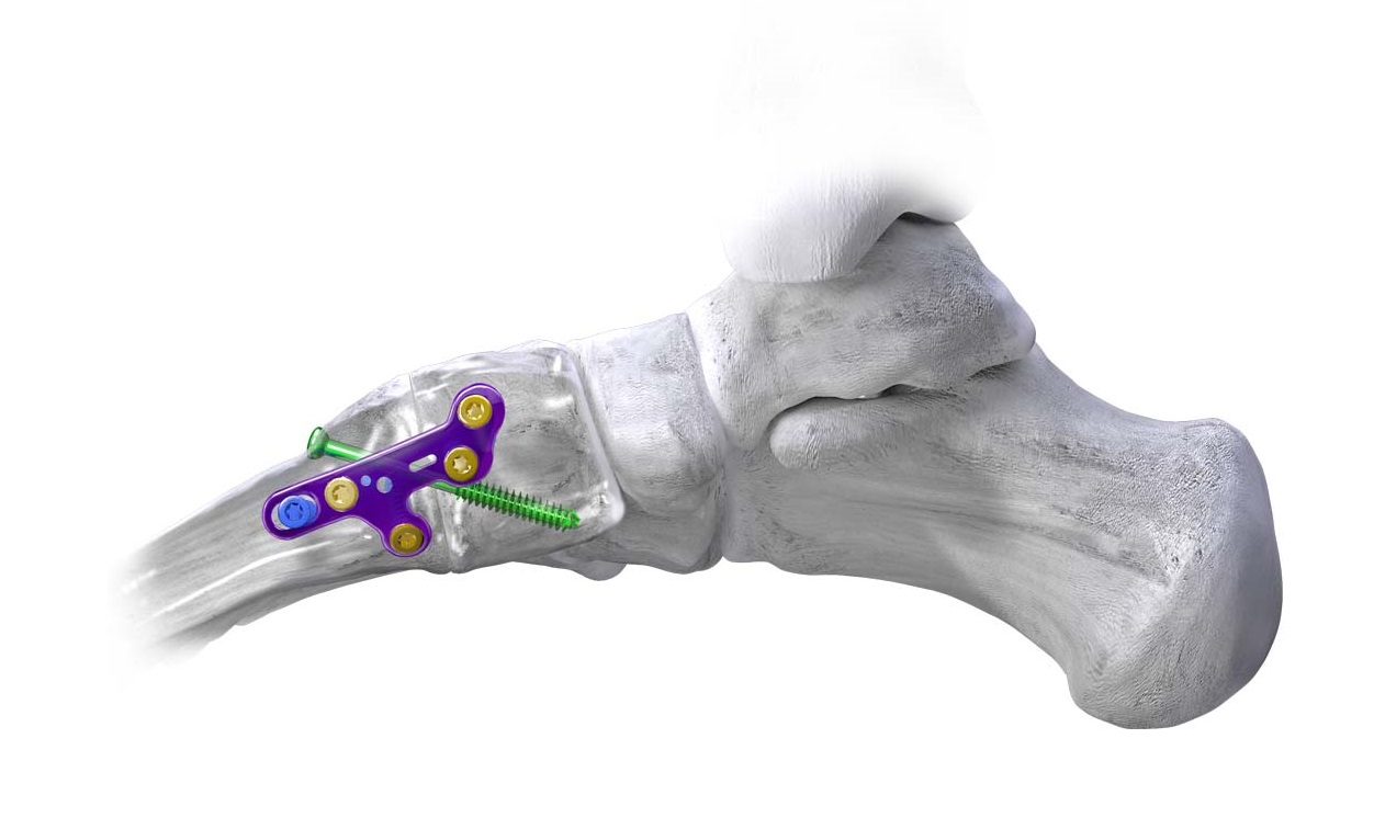 Gorilla® Lapidus Arthrodesis System