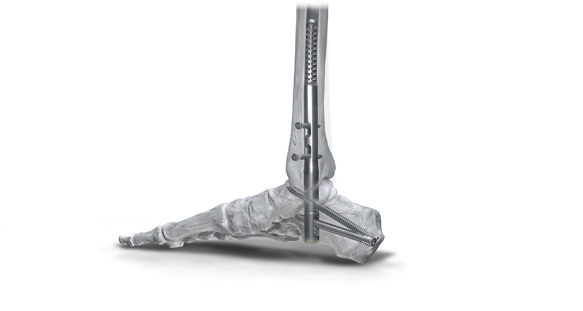 Phantom Hindfoot TTC/TC System