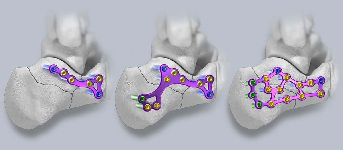 calc fracture