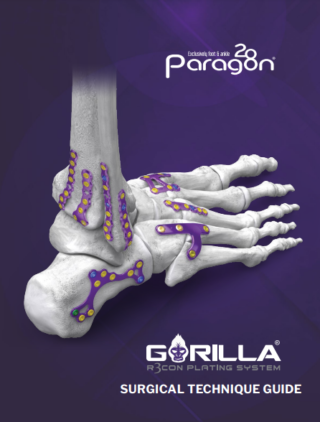 Gorilla® Medial Column Straddle Plates - Paragon 28